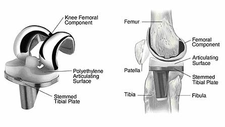 5. Totální endoprotéza kolenního kloubu Nejčastějším řešením těžkého postižení kolenního kloubu je v současné době implantace totální endoprotézy.