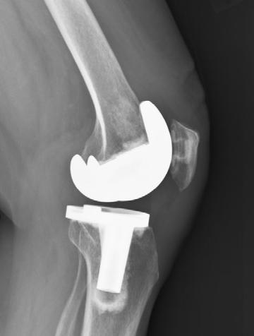 K operativní náhradě kolenního kloubu většinou vedou případy gonartrózy rezistentní na konzervativní terapii, což je nejčastější indikace k implantaci totální endoprotézy.