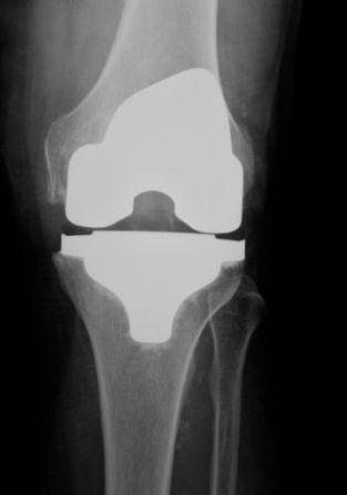 zlomeniny, destrukce kloubních povrchů) chronické instability, vrozených vad, systémových poruch postihujících pohybový aparát (hemofilie, dna, aseptické nekrózy) a nádorového ložiska v oblasti