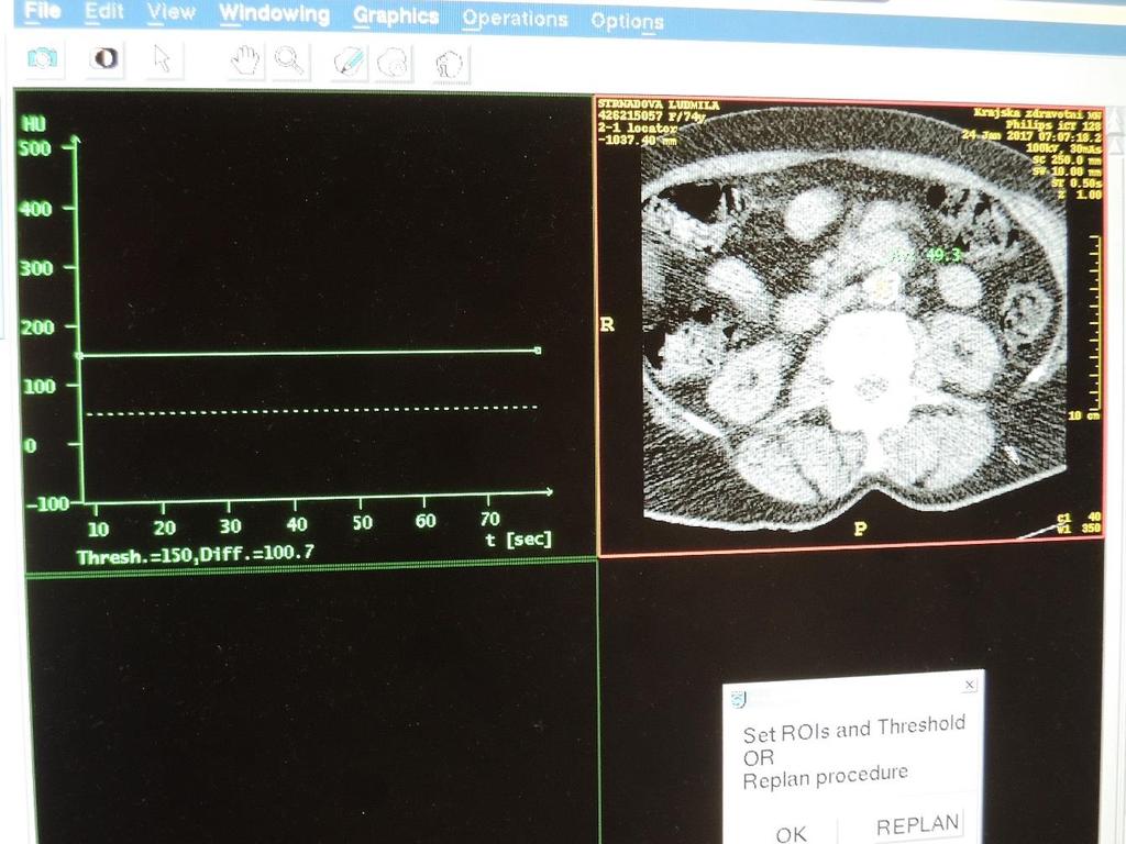 7.1 Vyšetřovací protokol CTA DK topogram -od renálních tepen po konečky prst směr skenování - kraniokaudálně kolimace/pitch (faktor stoupání) - 64x0,625/0,827 100kV u průměrné hmotnosti pacienta