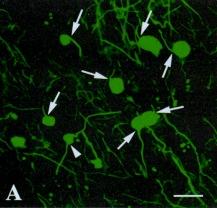 Axonal Transection in active MS