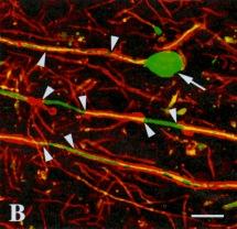 neurofilament) -demyelinated axons