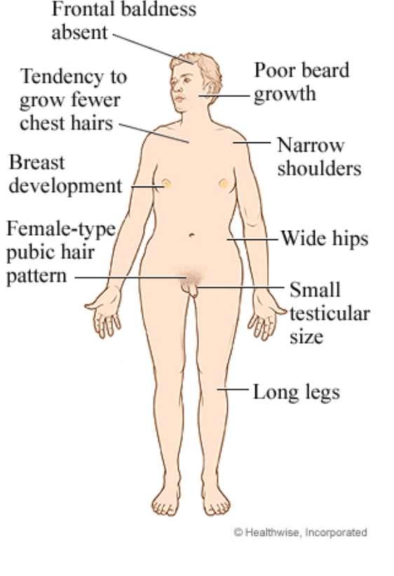Klinefelterův syndrom nadpočetný chromosom X u muže (47, XXY) : eunuchoidní habitus, infertilita gynekomastie,