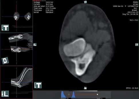 Obr. 6 RTG (LL projekce) pacient 2 pickou kontrolou byla provedena tenotomie ulnárního úponu m. biceps (Biceps Ulna Release Procedure = BURP). Rekonvalescence pacienta byla nekomplikovaná.