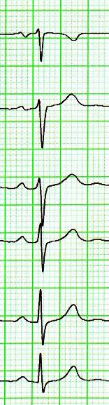 LBBB