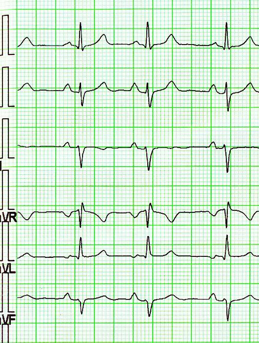 EKG sinusový