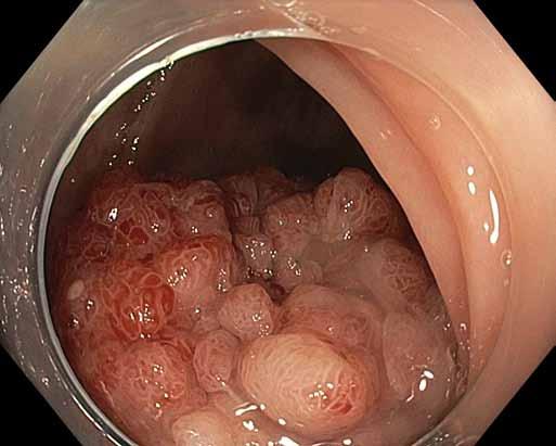 Transanální minimálně invazivní resekce rekta s totální mezorektální Hereditárny excizí angioedém po endoskopické ako príčina mukózní bolestí resekci brucha nodes, has already become a standard