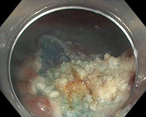 Adverse histological results after EMR do not necessarily need to lead to an indication for rectal resection with a permanent stoma, but there is a possibility of intersphincteric resection with