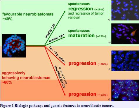 Specifika neuroblastomu Výrazná klinická a biologická variabilita onemocnění Spontánní regrese: 5 18% ( cca 10 100x více než u jiných