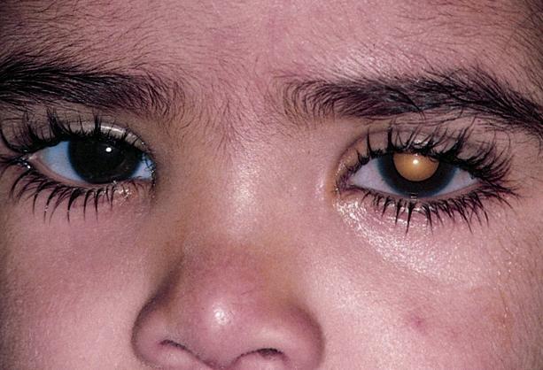 Retinoblastom Nejčastější primární nádor oka Původ v