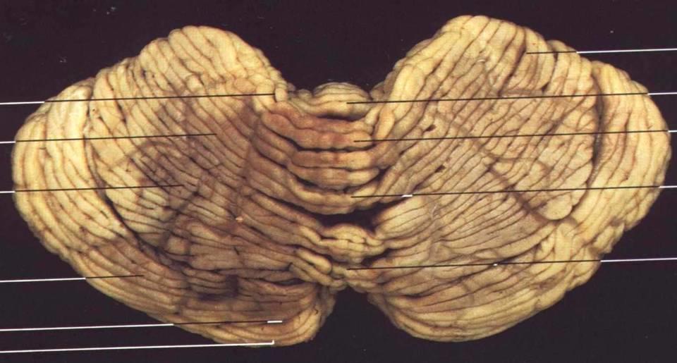 Cerebellum = Mozeček vermis (červ) nepárový uprostřed