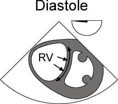 Cardiothorac Vasc Anesth 1994) Vzestup PVR vede k poklesu RVEF vzestup RVEDV a RV dilatace