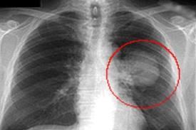 Předoperační vyšetření EKG (hypertrofie pravé komory) echokardiografie RTG Analýza arteriální krve (na vzduchu) Funkční plicní testy FEV1 - usilovná jednovteřinová expirační