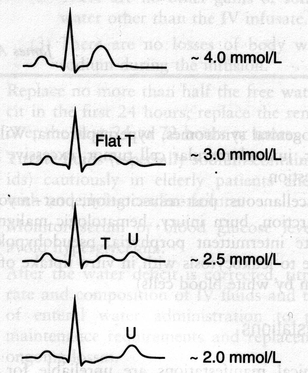 Hypokalemia K < 4 mmol/l ztráty ty močí diuretika, průjem, zvracení snížený příjemp alkalóza