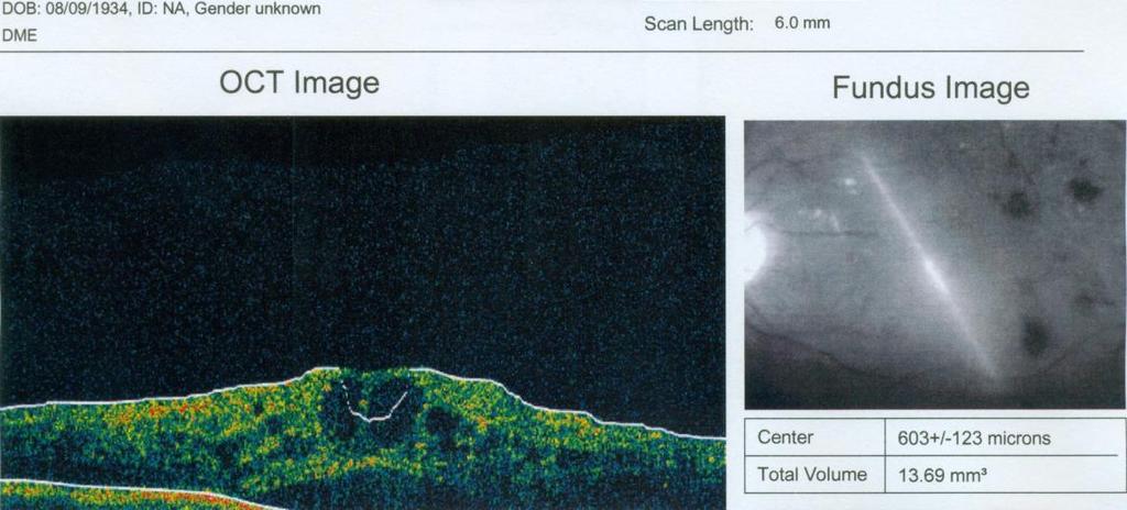 Vstupní NKZO byla 0,16 a makulární tloušťka 603 µm. Na OCT byl prokázán vysoký cystoidní edém s přítomností ablace vrstvy neuroepitelu sítnice.