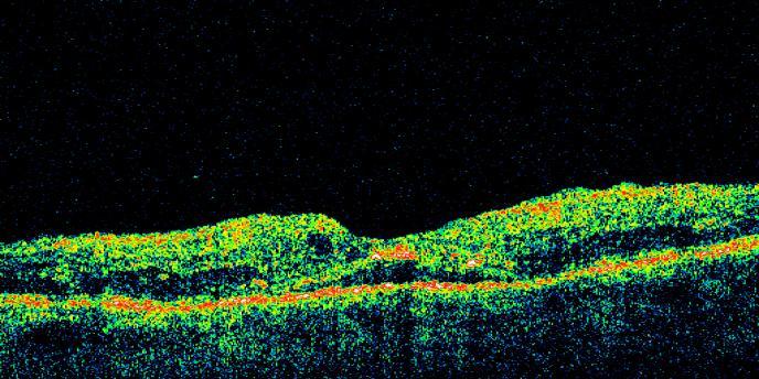MT 603 ± 123µm  17: OCT OL 1