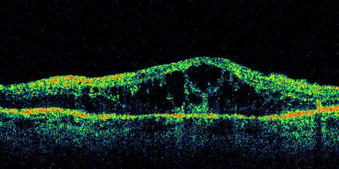 6µm  18: OCT OL 6 měs.