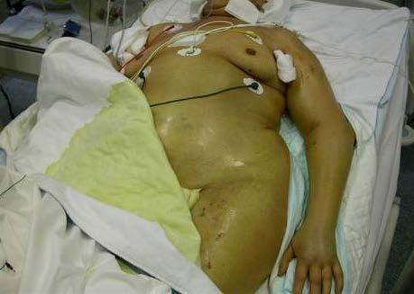 Prevence a léčba AKI nové koncepty A) TEKUTINY Kvalitativní toxicita