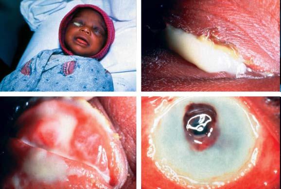 Kapavka (GO): ostatní lokalizované infekce proctitis pharyngitis