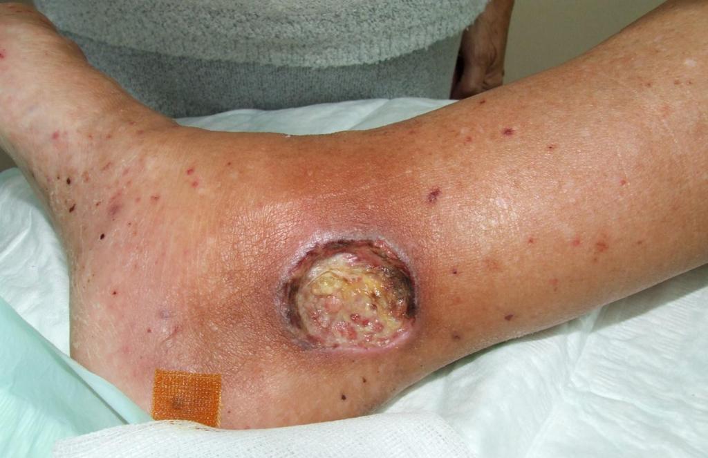 Příklad klinického použití krytí se stříbrem Pacient s nehojícím se bércovým vředem venozní etiologie v oblasti vnitřního kotníku pravé dolní končetiny a klinicky manifestní rannou infekcí
