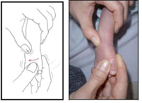 Obr. 11. Manipulační technika (Lohan, 2009) Redukce kavózní deformity Prvním základním prvkem korekce je odstranění kavózní deformity.