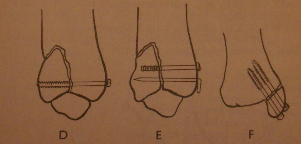 suprasyndesmální šroub, C dvojice suprasyndesmálních šroubů a současná osteosyntéza vnitřního