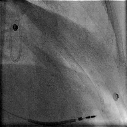 Diagnostics shot in a 3VD patient
