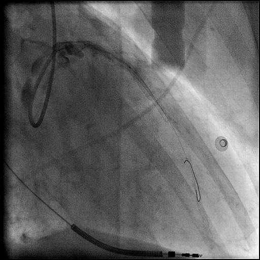 PCI on ECMO no
