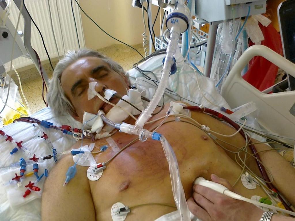 Peripheral ECMO O 2 subcl./axil. art.
