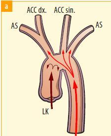 ECMO and LV interaction