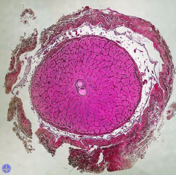 Fasciculus opticus optický nerv - Obaly: dura mater,