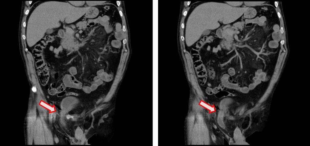 237 bladder herniation, by obstruction of lower urinary tract or both.