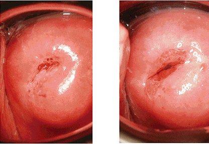 Portio vaginalis cervicis