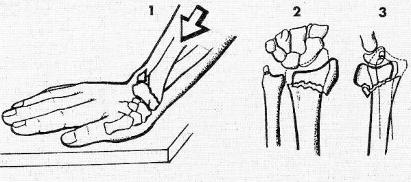 2.3.2 Diagnostika zlomenin Anamnéza: zjišťujeme mechanismus úrazu, který napovídá o poranění měkkých tkání, u únavových a patologických zlomenin je podrobná anamnéza zcela nezbytná (Valenta, 2007).