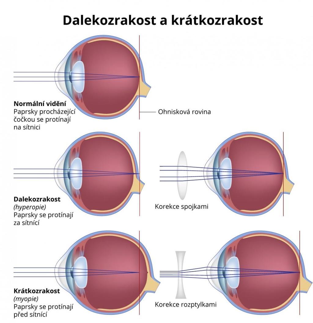 Pokud se obraz předmětu umístěného ve větší vzdálenosti než 5 metrů zobrazuje před sítnicí, jedná se o myopii neboli krátkozrakost.