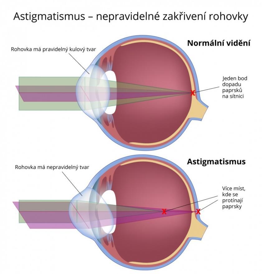 se doporučuje plná korekce, kterou děti zvládají lépe než dospělí jedinci. Kontaktními čočkami u dětí se vada koriguje v lékařem indikovaných případech.