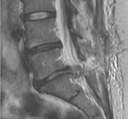 Syndrom cauda equina A 30-year-old female with a previous history of lumbar microdiscectomy presents with increasing low back pain and new onset urinary incontinence Poruchy citlivosti