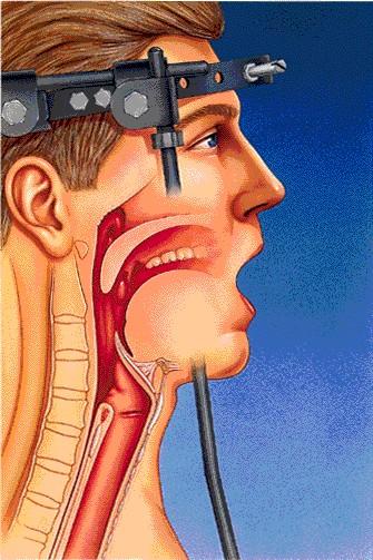 INSERTION OF THE LMA