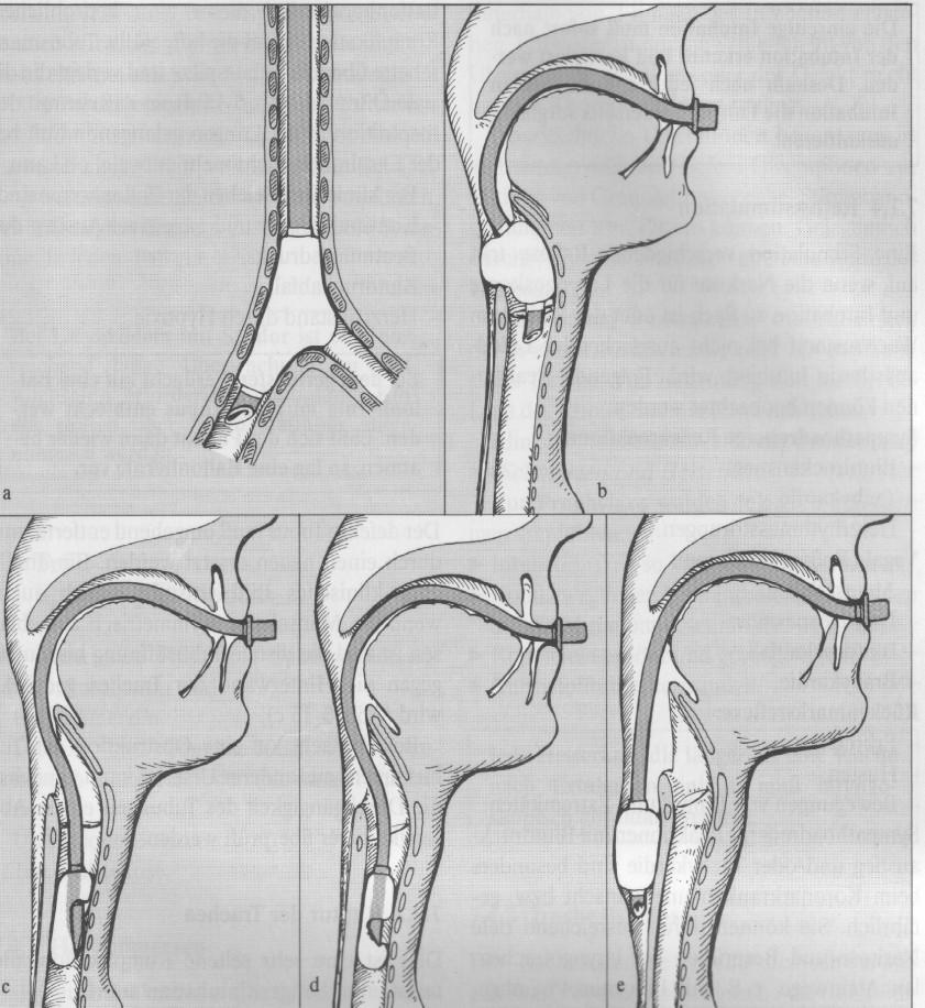 Komplikace TI - časné: poranění zubů, měkkých tkání chybná intubace do jícnu /