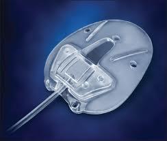 46 Schéma drenážního implantátu Obázek.47 Moltenův implantát Ze studií sledujících pooperační stav starších pacientů vyplývá úspěšnost v prvním roce po operaci 70 90 %.
