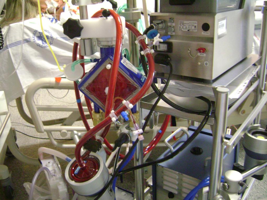 Konfigurace ECMO systému Oxygenátor Inflow kanyla Outflow kanyla
