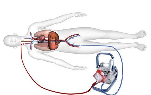 2. ECLS/ECMO Extracorporeal life