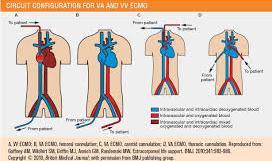 (ECLS/ECMO) is a technique of providing support