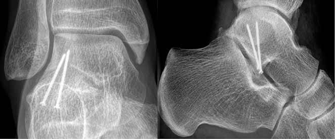 401/ Acta Chir Orthop Traumatol Cech. 83, 2016, No. 6 PŮVODNÍ PRÁCE fragment s linií jdoucí od talofibulární plochy výběžku až do talokalkaneární části II.