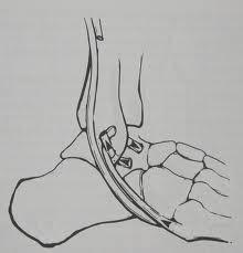 : Operační postup dle Evanse (Dungl et al., 2005, 1056).