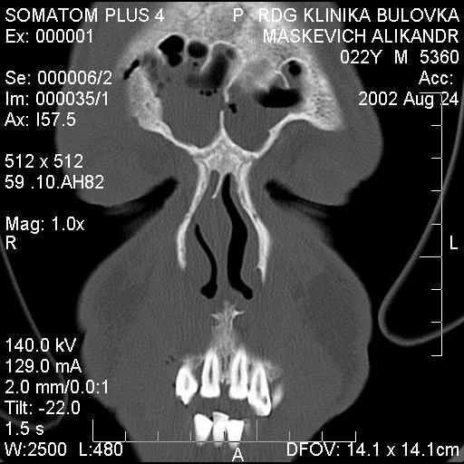 sinus do přední jámy lební, došlo ke komunikaci frontální