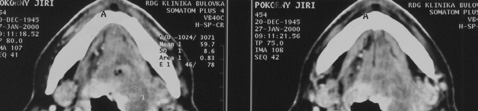 III. Dutina ústní, orofarynx, dutina nosní, nasofarynx Vyšetřovací metody klinicky těžko dostupná