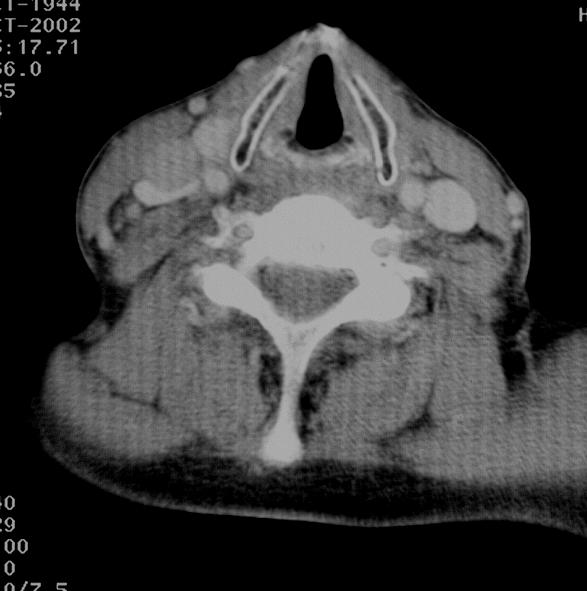 V. Larynx - anatomie Larynx Hlasivkové vazy Chrupavka štítná Arytenoidní