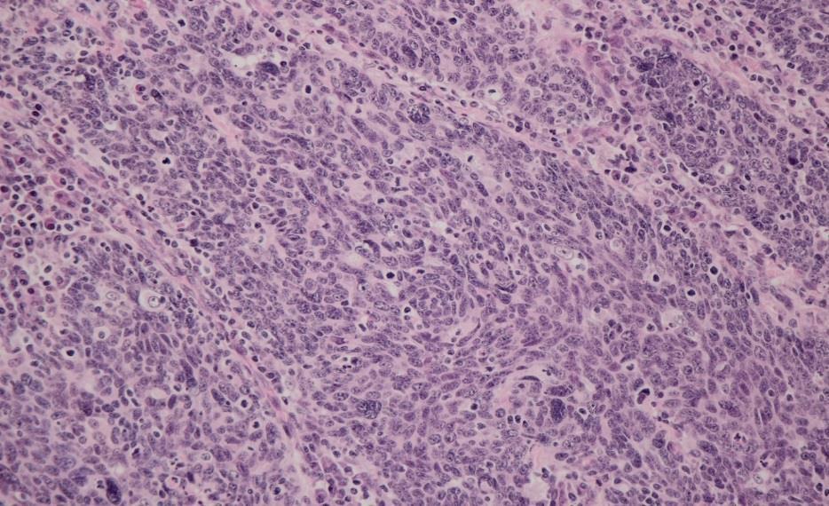 po jednom vzorku (1,2 %). Dále byly zjištěny vícenásobné infekce u dvou pacientů (2,4 %), jeden vzorek byl pozitivní na HPV 16 a 18, druhý na HPV 11 a HPV 16.