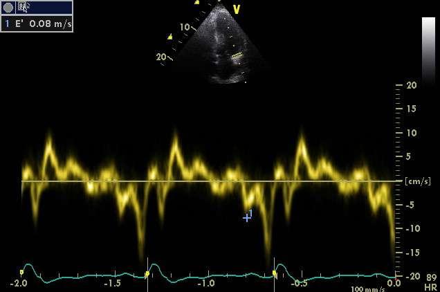 by myocardium (TVI) S1, S2,